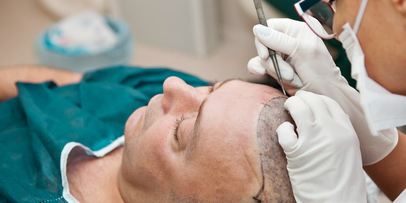Hair Transplant UK – Step-by-Step Guide to the Procedure
