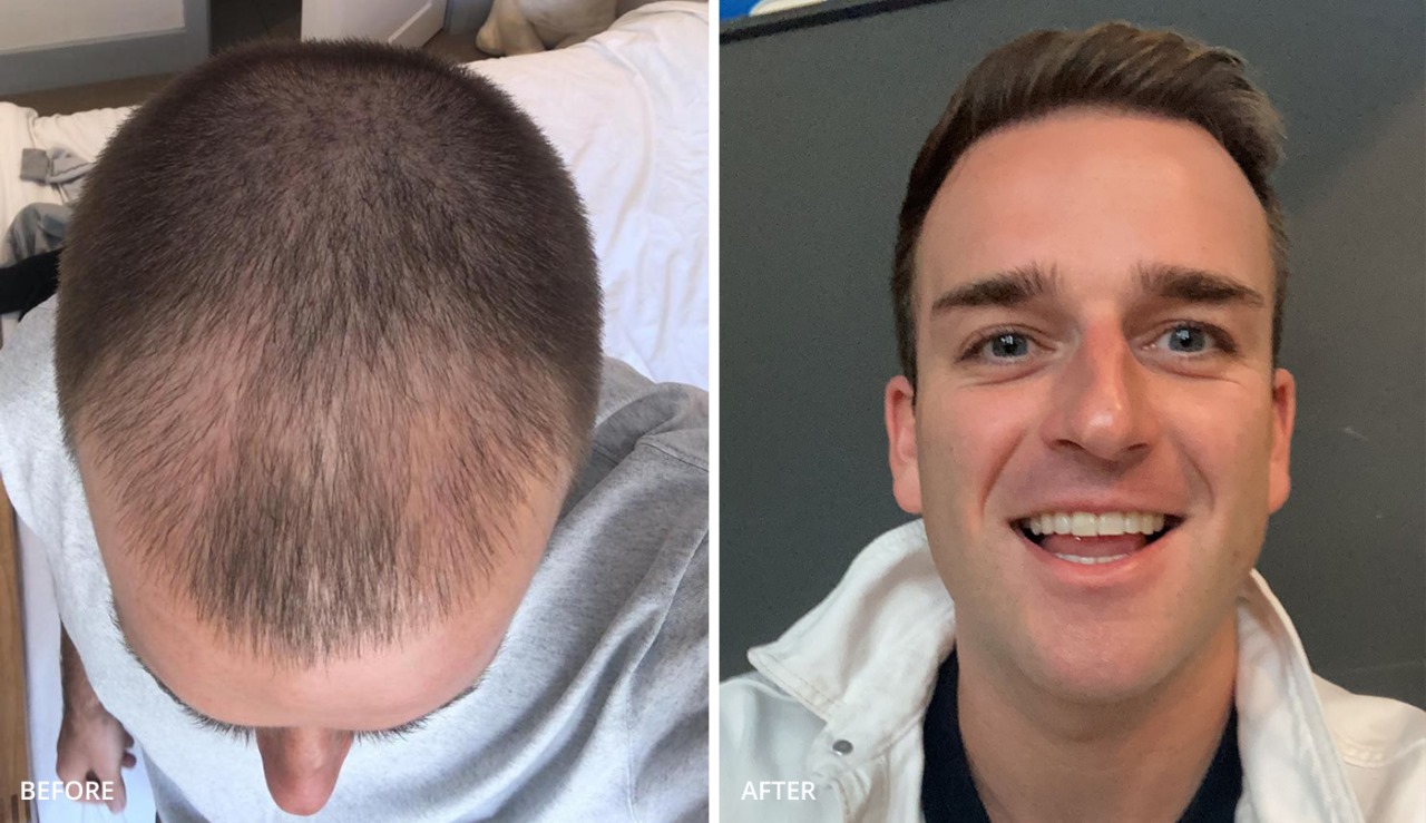 Hair Transplant UK Reviews – See Why We’re Rated 5 Stars