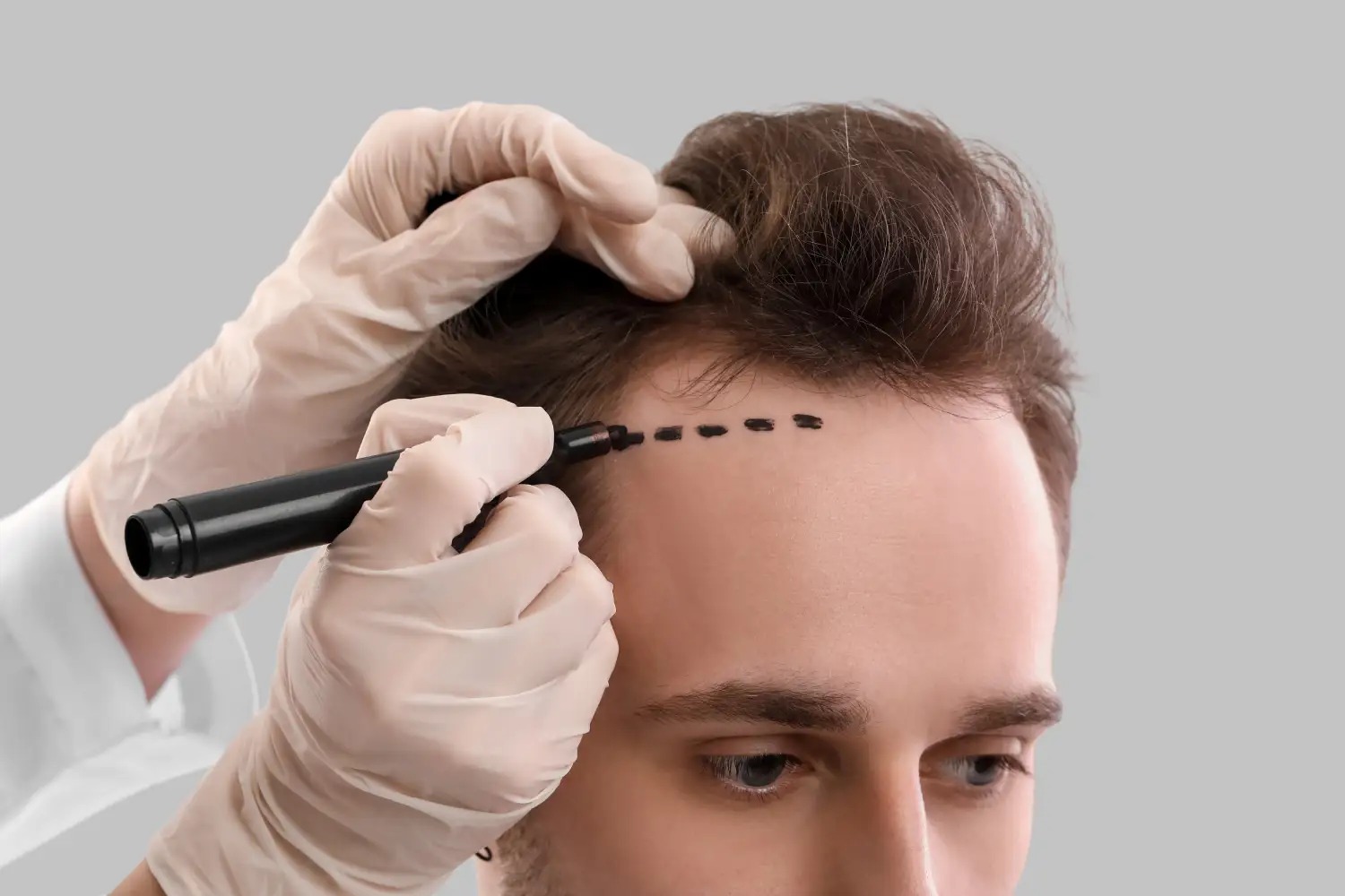 Hair Transplant Turkey: Expert Care from Start to Finish
