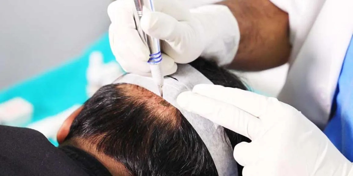 Hair Transplant Istanbul at Sapphire Hair Clinic – Book Today