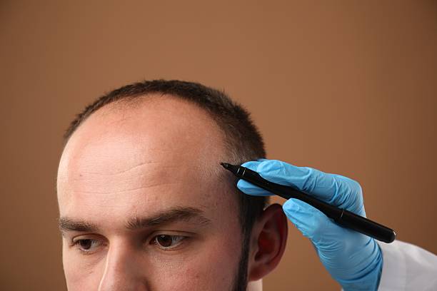 Hair Transplant Price: What You Should Expect to Pay